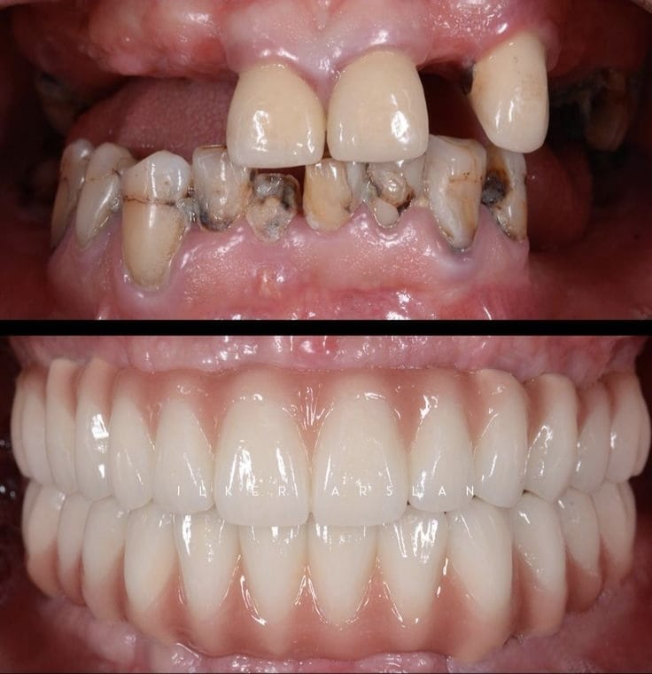 Full Mouth Rehabilitation in Vasai