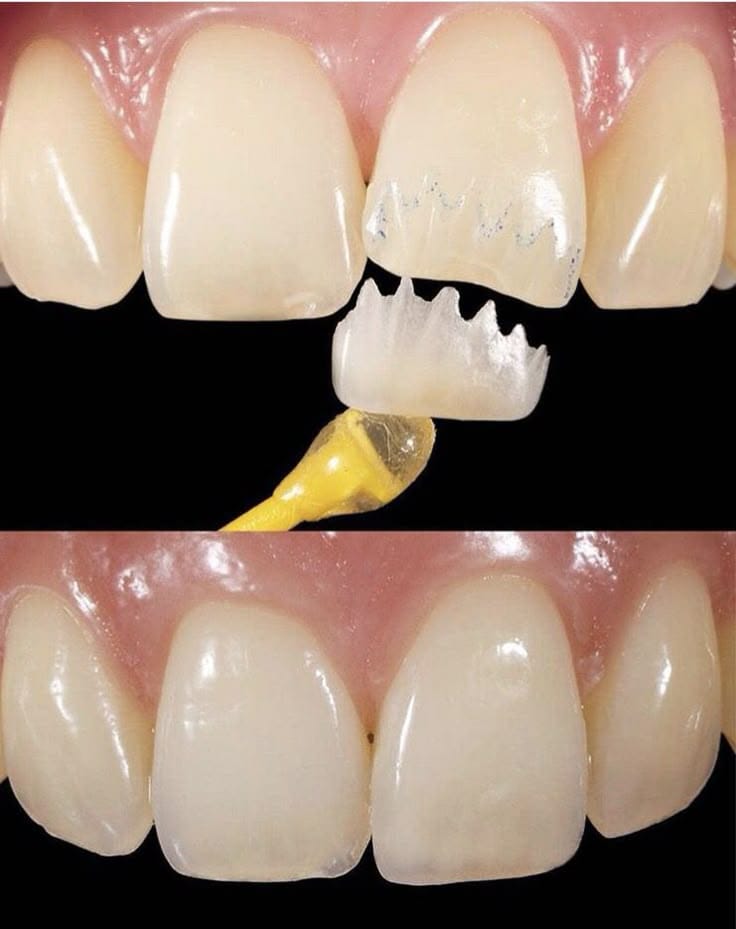 Restorative Dentistry in Vasai East